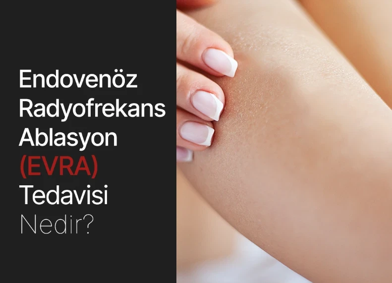 Endovenöz Radyofrekans Ablasyon (EVRA) Tedavisi Nedir?