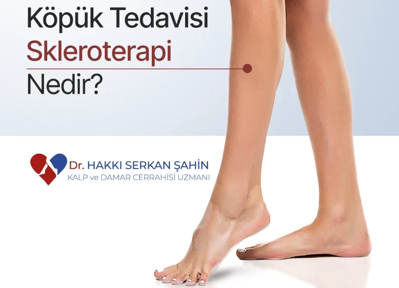 Köpük Tedavisi Skleroterapi Nedir?