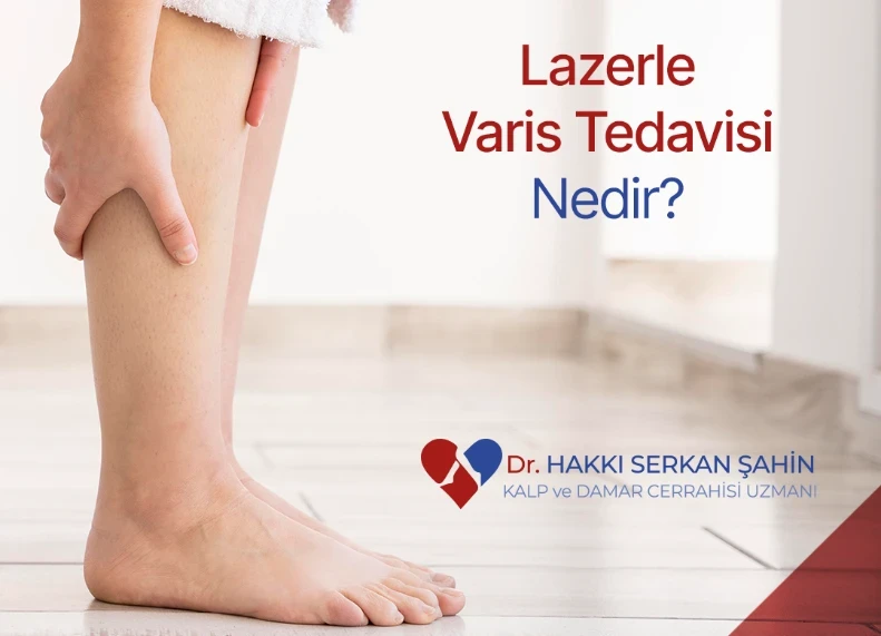  Lazerle Varis Tedavisi Nedir?